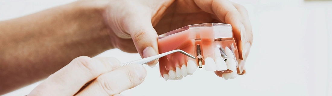 Dental Implant Anchor In Bite Model